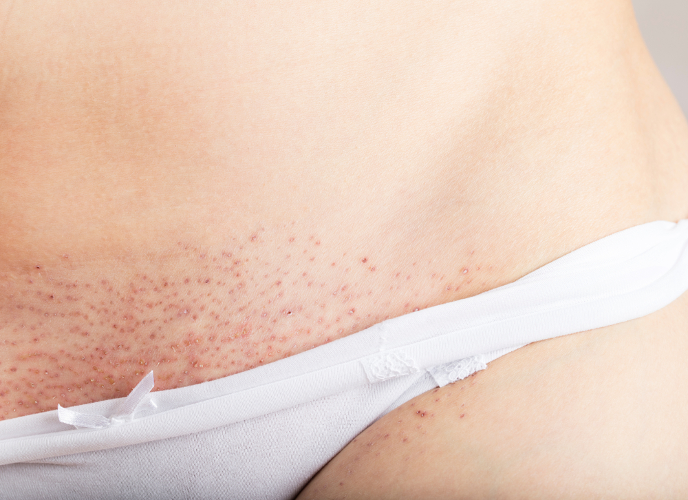 How Can You Reduce Irritation When Removing Pubic Hair?